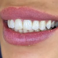 Composite Bonding - Smile 17 before